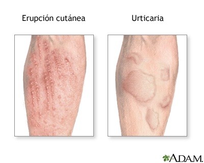 alergias-o-problemas-de-piel-cuida-tus-pulmones-erupciones